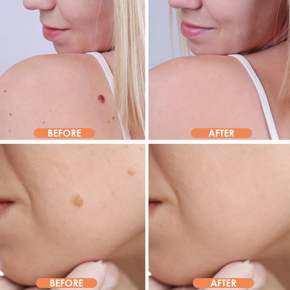 Mole & Dark Spot Removal Pen