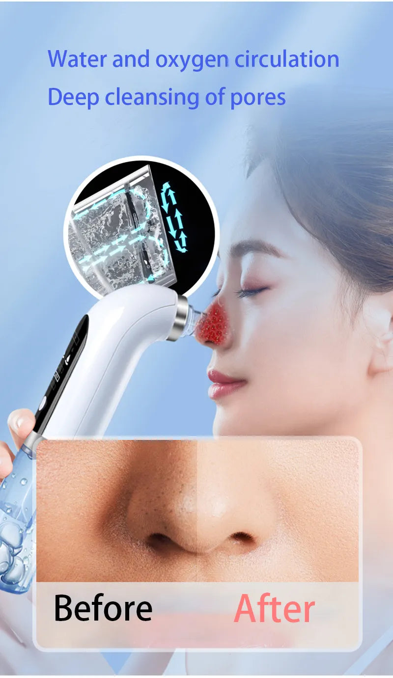 Blackhead Pore Vacuum &amp; Cleanser