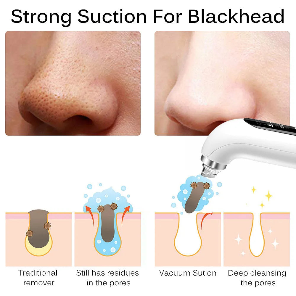 Blackhead Pore Vacuum &amp; Cleanser