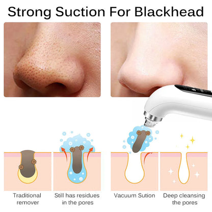 Blackhead Pore Vacuum &amp; Cleanser